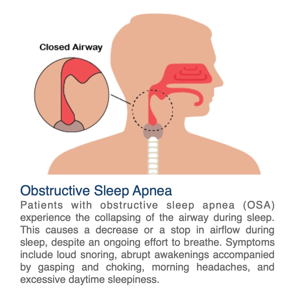 Bongo Rx, OSA closed airway