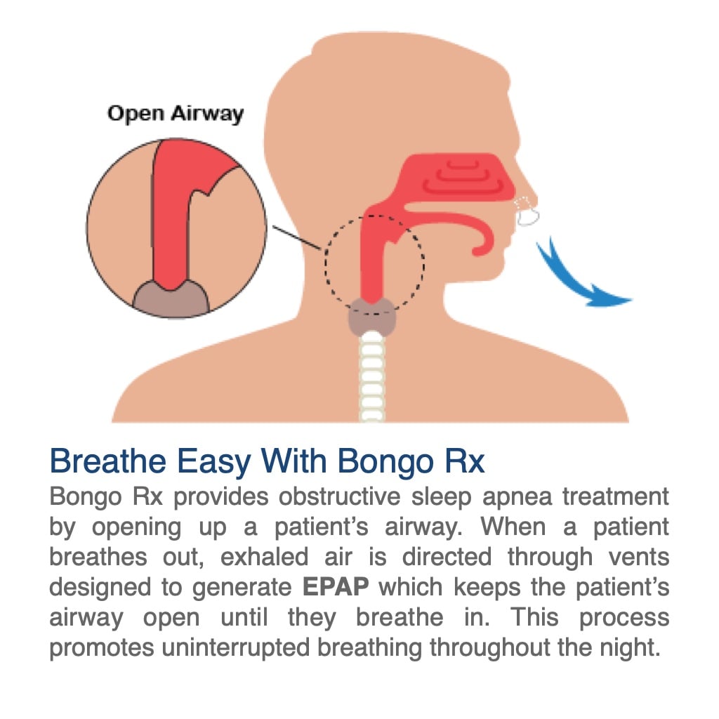 Bongo Rx, OSA open airway